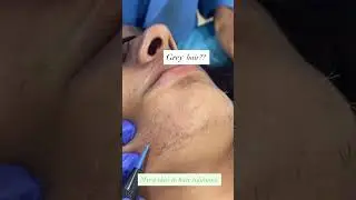Permanent facial hair removal with electrolysis #hairremoval #electrolysis #whitehairtreatment #hair