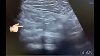 Ultrasound of Inguinal hernia showing bowel loops