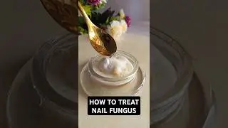 How to treat nail fungus at home with garlic, baking soda & apple cider vinegar. #nailfungus #nails