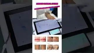 808 diode laser hair removal machine