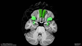 THC Exposure is Reflected in the Microstructure of the Cerebral Cortex and Amygdala of Young Adults