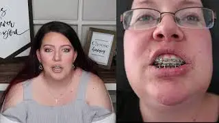 Jaw Surgery Update | Correction Surgery | + first few days of recovery VLOG