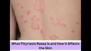 Pityriasis rosea; triggered by a viral infection possibly human herpesvirus 6 or 7
