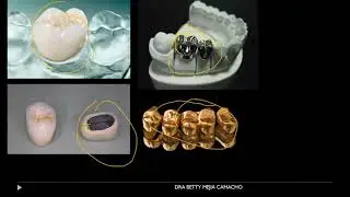 corona completa de metal