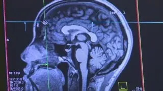 UNM brain study probes criminal pattern