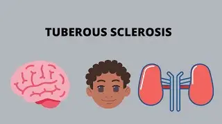 Tuberous Sclerosis | Neuro-cutaneous Syndromes | Genetics | Clinical features |