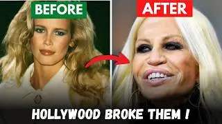 THEN vs NOW: When Plastic Surgery Ruined Celebrities. #PlasticSurgery #CosmeticSurgery