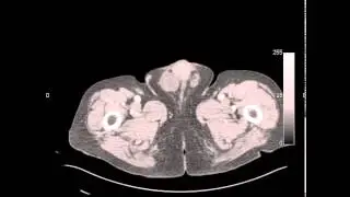 angioscanner aorte membres inf&eacute;rieurs
