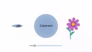 Cataract Surgery Fixed vs  Adjustable Lenses | RX Sight | Light Adjustable Lens