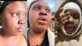 A lady got burnnt with bo!Iing water by her boyfriend&rsquo;s sister because she didn&rsquo;t greet her back 😭💔