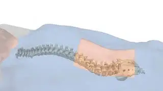 Advanced Spinal Correction - 3D Spine Implant Animation Everest Deformity by Pulse 3D Media