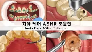 ASMR teeth care animation | collection cavities | wisdom teeth | tonsils stone removal animation