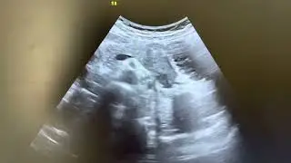 Hypoechoic area in tail. Pancreatic tail is best visualized with extremely full stomach with water