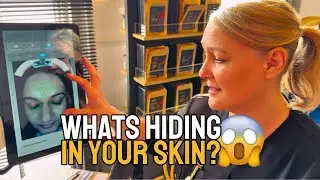 Korean Skin Analysis with AI Tech| Pores, Wrinkles & Skin Health Check| Derby Skin Clinic