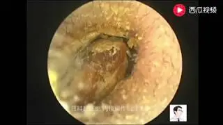 Earwax Removal Extraction,Ceruminal block of two children and one adult, 13 minutes