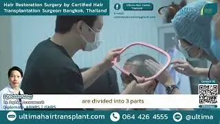 Get to know Dr. Ming, ABHRS hair transplant surgeon at Ultima Hair Transplant Center