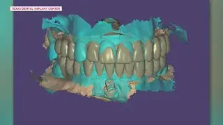 AI-driven smile design in Houston: Full-arch transformations at Texas Dental Implant Center