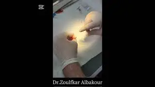 metal post and core dental procedure [3]