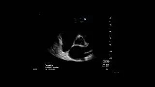 How to...Measure Mean Pulmonary Artery Pressure From Tricuspid Regurgitation