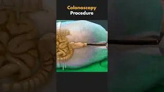 how colonoscopy is performed? #medical #medicalshorts #3dmedicalanimation