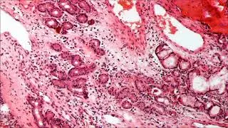 Terapia de sonido para alergias o sinusitis (787 Hz) - 30 minutos