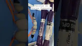 Facetas de resina composta direta! #dentes #dentistas #odontologia