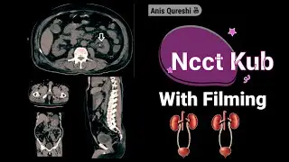 Ncct Kub with Filming| By Anis Qureshi