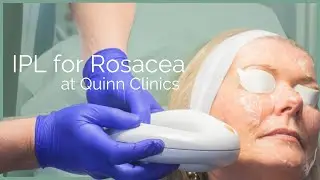 Intense Pulsed Light (IPL) on Sun Spots at Quinn Clinics Bristol + Lumenis M22 Filters