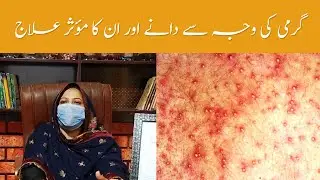 Heat Rash Boils: Causes & Treatment | گرمی کی وجہ سے دانے اور ان کا مؤثر علاج