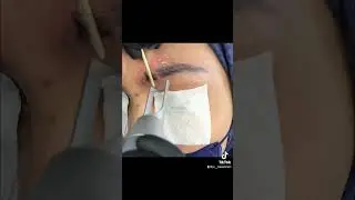 Laser Alis Sulam!! Lgsg keliatan Hasilnya! #laser #viral #tiktok #alis #lasertattooremoval #tattoo #