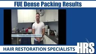 Restoring Hair : FUE Dense Packing Results - Hair Restoration Specialists of Atlanta