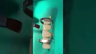 Composite veneers #teethrestoration