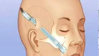 Endotine&reg; Midface ST