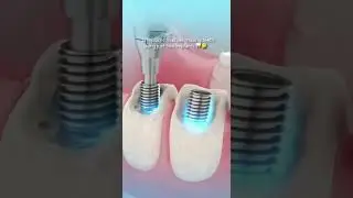 Dental Implant Bridge Animation 🦷 | How It Works Explained in 15 Seconds! #shorts