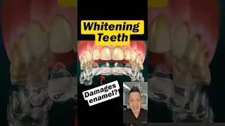 Safe or Risky? What Teeth Whitening Does to Enamel #dentallan #dentist #shorts