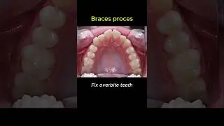 How to fix overbite teeth? Braces process transform #dentist #braces #orthodontist