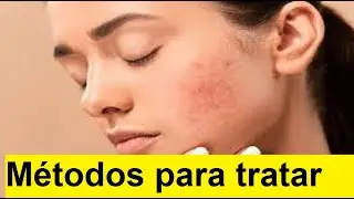 M&eacute;todos para tratar el acn&eacute;