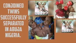 CONJOINED TWINS SUCCESSFULLY SEPARATED IN ABUJA NIGERIA.