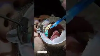 VENEER INSERT - NORTH BRISBANE - DENTIST