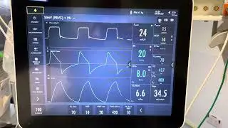 SIMV PRVC+PS