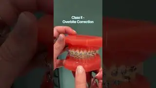 How to Wear Elastics