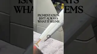 Pigmentation isn&rsquo;t always what it seems | SKIN CLINIC IN DUBAI #Dubai #hyperpigmentation #melasma
