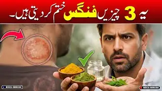 Best Remedy for Fungal Skin Infection | Fungal infection ka ilaj | Fungus treatment at home .