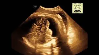 megacisterna magna, vermis intact , 4th ventricle normal, no upward rotation of vermis (angle is 0)