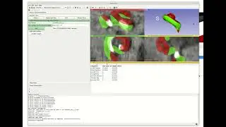 Automatic Cochlea Multimodal 3D Image Segmentation And Analysis
