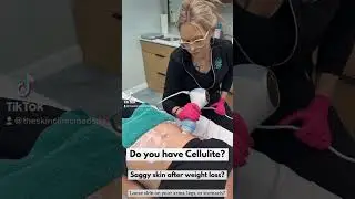 How to treat cellulite with Emtone