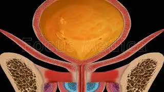 Cystometry - Animated Atlas of BPH and OAB
