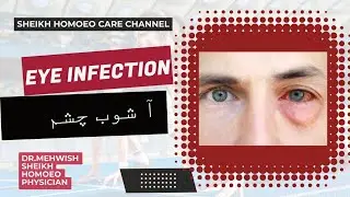 Eye Infection Homoeopathic Medicine Treatment | red eyes l itching eyes l آ شوب چشم 