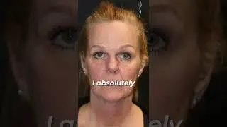 FACELIFT BEFORE AND AFTER -🧑&zwj;⚕️- Dr. Scott Holley #beforeandafter #plasticsurgerybeforeandafter