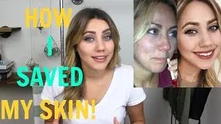 How I Beat My Acne | Oil Cleansing Method